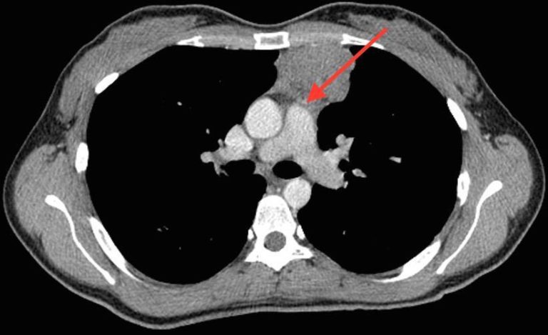 Тимома: что это такое, симптомы, лечение и прогноз
