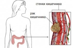 Рак толстой кишки: симптомы и лечение опухоли толстого кишечника в Одессе