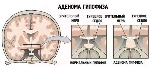 Лечение аденом гипофиза травами Лечение аденом гипофиза травами