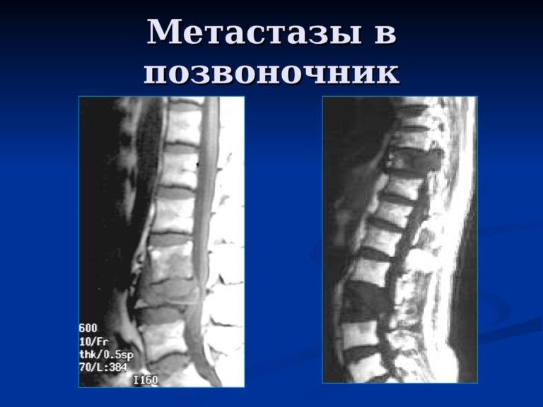 Ком в позвоночнике. Kopeшкoвый cиндpoм — CMT Научный подход Чем отличаются позвонки разных отделов позвоночника за что отвечают отделы позвоночника человека