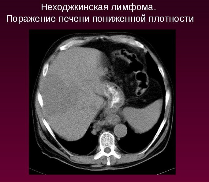 Неходжкинская лимфома - что это такое, симптомы и фото