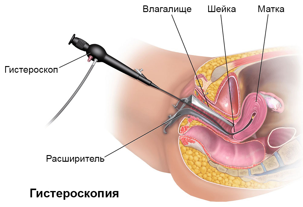 Раздвинула влагалище расширителем68