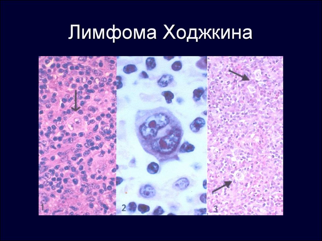 Лимфоидная опухоль. Клетки Ходжкина гистология. Лимфома Ходжкина микропрепарат. Лимфоузел при болезни Ходжкина микропрепарат. Лимфома Ходжкина лимфоузлы поражение.