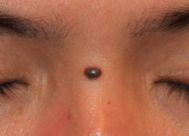 Признаки меланомы кожи фото начальная стадия фото