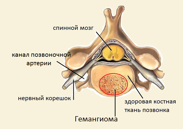 Гемангиома позвоночника рисунок