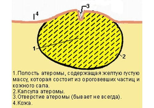 Атерома: что это, причины, симптомы, лечение и фото