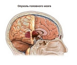 опухоль головного мозга