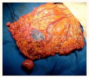 Перитонеальный канцероматоз лечение народными средствами thumbnail
