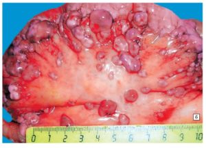 Канцероматоз брюшины при раке: что это такое, симптомы, причины канцероматоза брюшной полости, прогноз