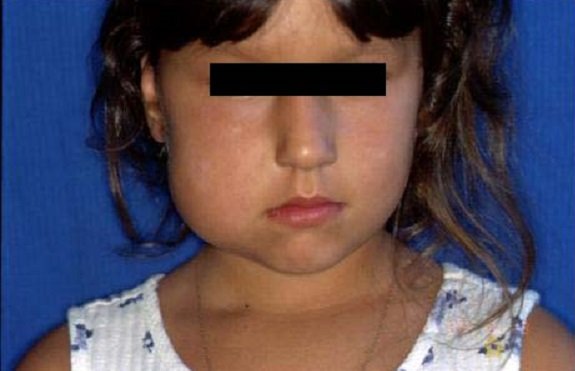 Лимфангиома - что это такое, симптомы, лечение и фото