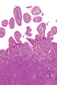 Неходжкинская лимфома под микроскопом