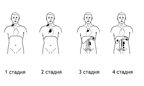 Лимфома - что это такое, симптомы, признаки и лечение