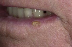 Плоскоклеточная карцинома губы