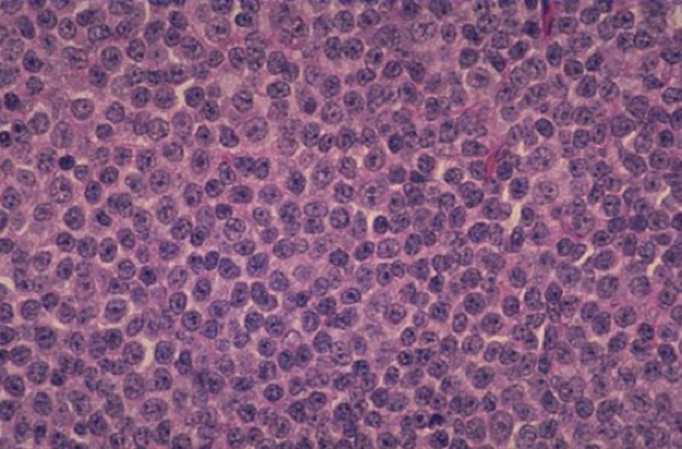 Неходжкинская лимфома - что это такое, симптомы и фото