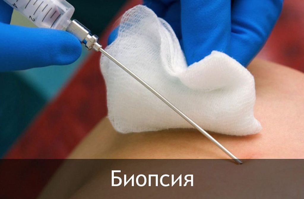 Аденома надпочечника у женщин и мужчин - симптомы и лечение