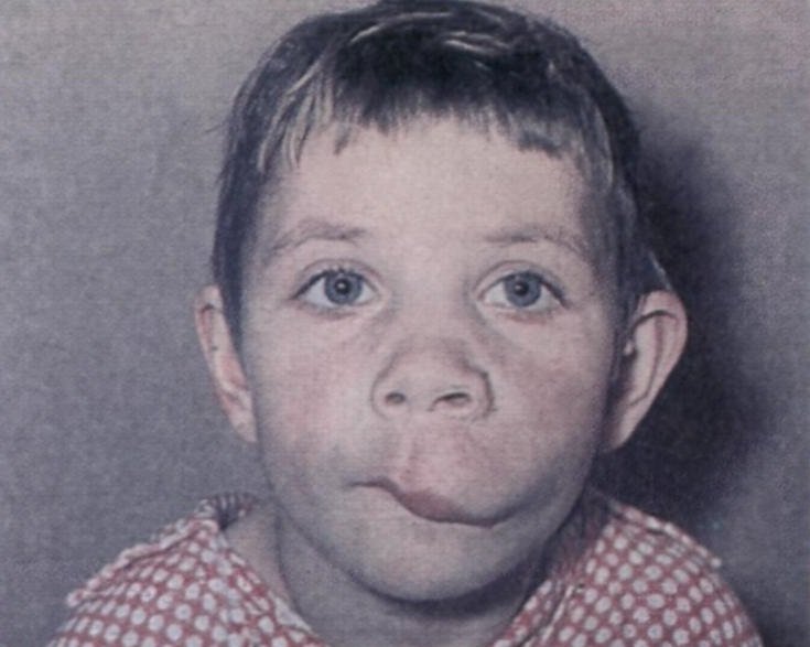 Лимфангиома - что это такое, симптомы, лечение и фото