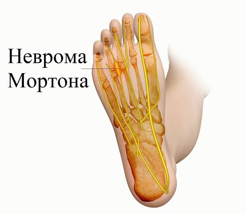 Неврома Мортона - симптомы, лечение и что это такое
