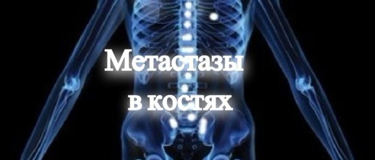 Метастазы в кости срок жизни