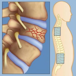 Метастазы в костях патологические переломы