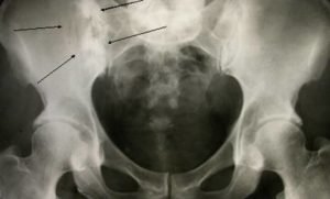 Метастазы в кости переломы могут быть thumbnail