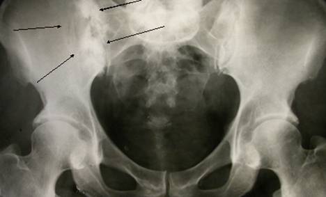 Метастатическое поражение костей. Остеобластические метастазы рентген. Метастаз подвздошной кости рентген. Опухоль подвздошной кости рентген. Остеобластические метастазы в кости таза рентген.