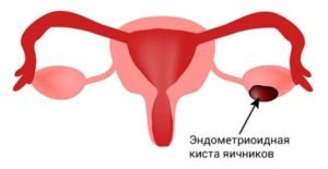 Эндометриоидную кисту яичника следует дифференцировать thumbnail