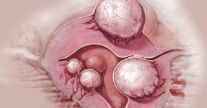 Эндометриоидная киста яичника или опухоль