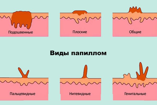 Папилломы - что это такое, способы лечения и фото