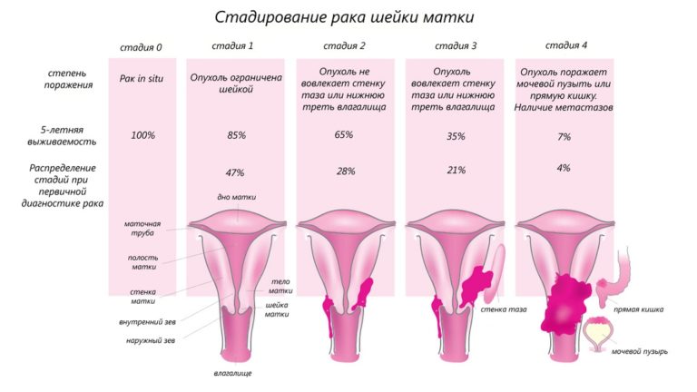 Стадии рака груди фото