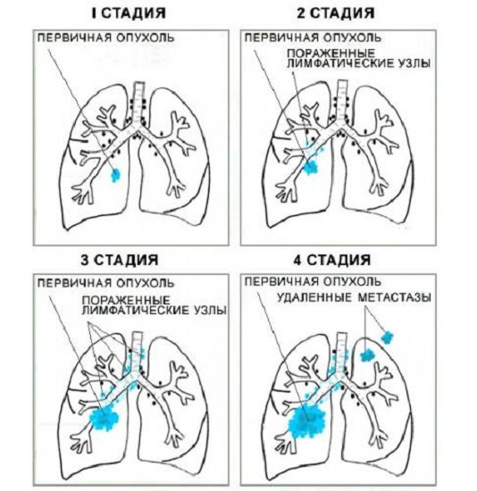 Рак ротоглотки фото начальная стадия