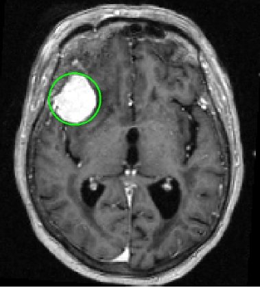 Как выглядит опухоль головного мозга на мрт фото