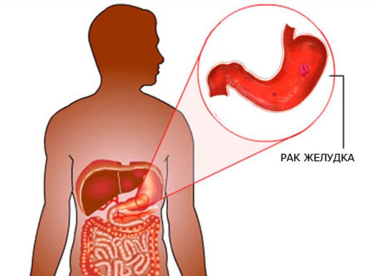 Признаки рака желудка - первые симптомы и проявления