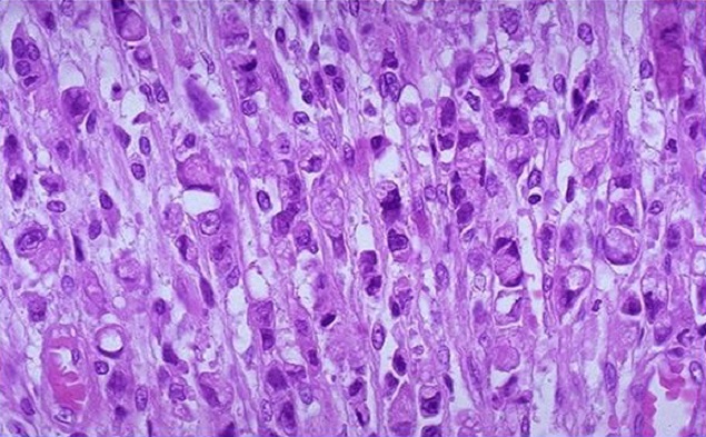 Аденокарцинома желудка - что это такое, симптомы и прогноз