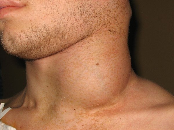 Рак лимфоузлов - симптомы, признаки, лечение и фото