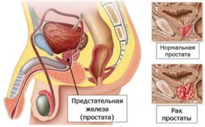 Злокачественная опухоль предстательной железы симптомы и лечение thumbnail
