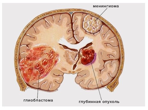 глиобластома, менингиома и глубинная опухоль