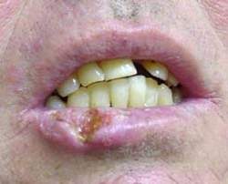 Опухоль верхней губы при простуде фото