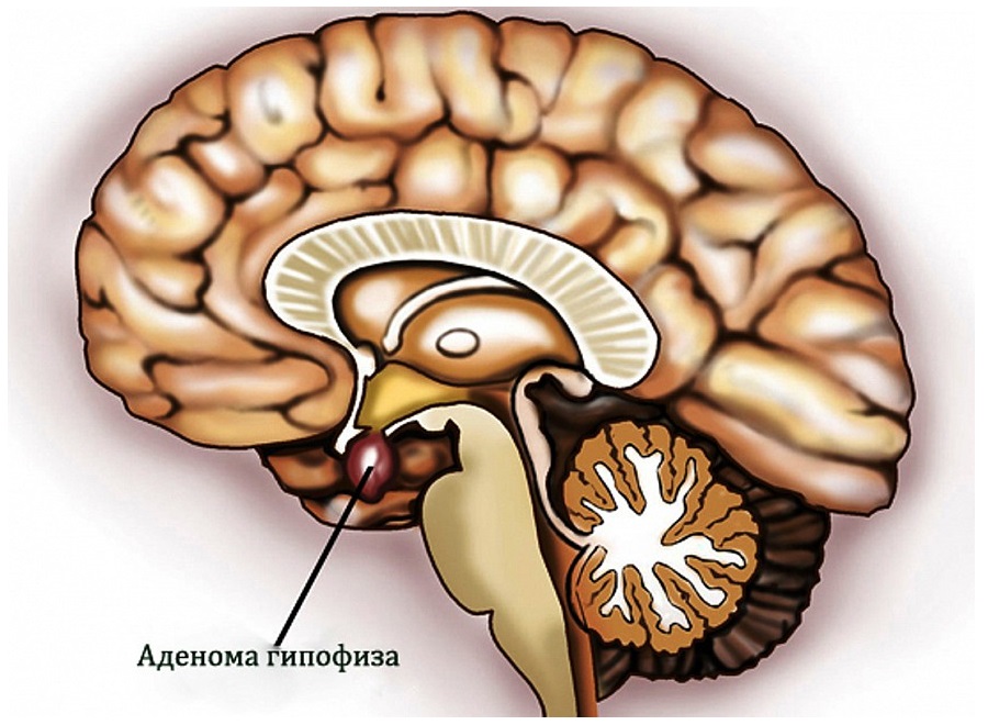 Микроаденома гипофиза: что это такое и чем опасна