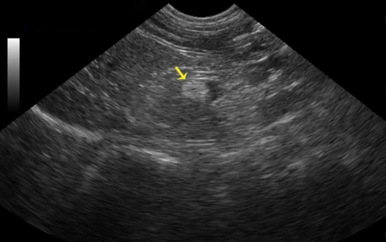 Аденома надпочечника у женщин: симптомы и лечение