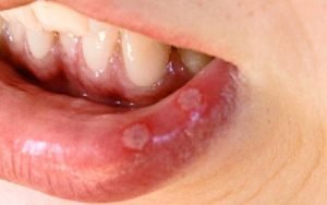 Рак кожи лица губы