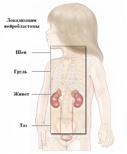 Нейробластома у детей презентация