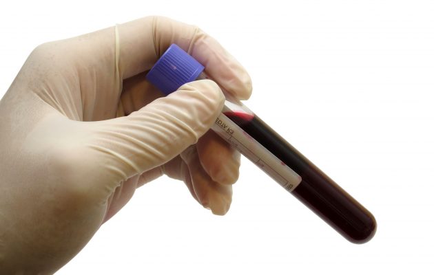 Что показывает онкомаркер SCC? Расшифровка и норма