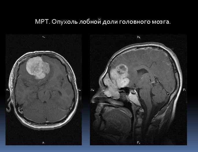 Клиническая картина опухоли головного мозга