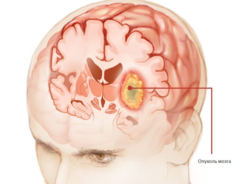 Признаки опухоли головного мозга, и симптомы на ранних стадиях