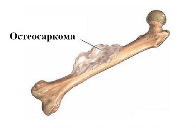 Остеосаркома: что это, симптомы, причины, лечение и фото
