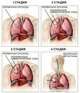 стадии рака лёгких