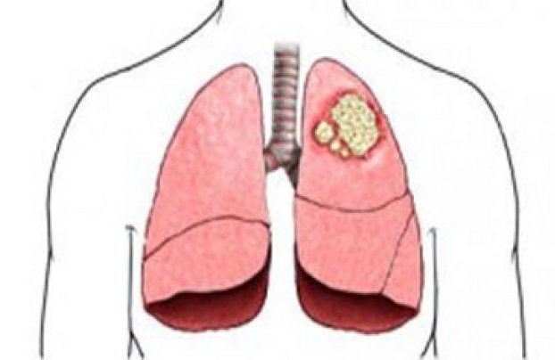 Рак легких: симптомы и признаки на ранней стадии