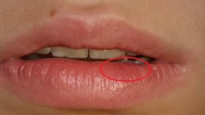 Опухоль верхней губы при простуде фото thumbnail