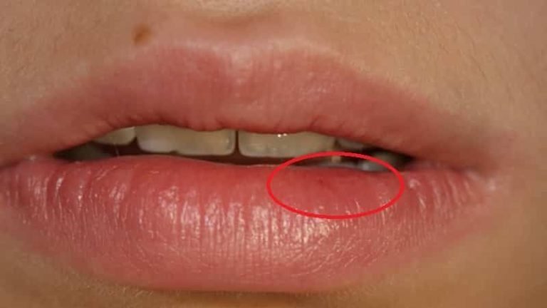 Как выглядит рак губы начальная стадия фото