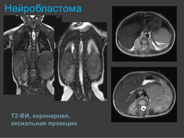 Нейробластома. Нейробластома забрюшинного пространства 4 стадия. Нейробластома забрюшинная симптомы. Нейробластома брюшной полости 4 стадия. Нейробластома забрюшинного пространства.